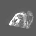 Cardiac fibroma (Radiopaedia 38974-41150 SAXs Cine 2).jpg