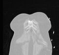 Cardiogenic pulmonary edema (Radiopaedia 29213-29609 Coronal lung window 1).jpg