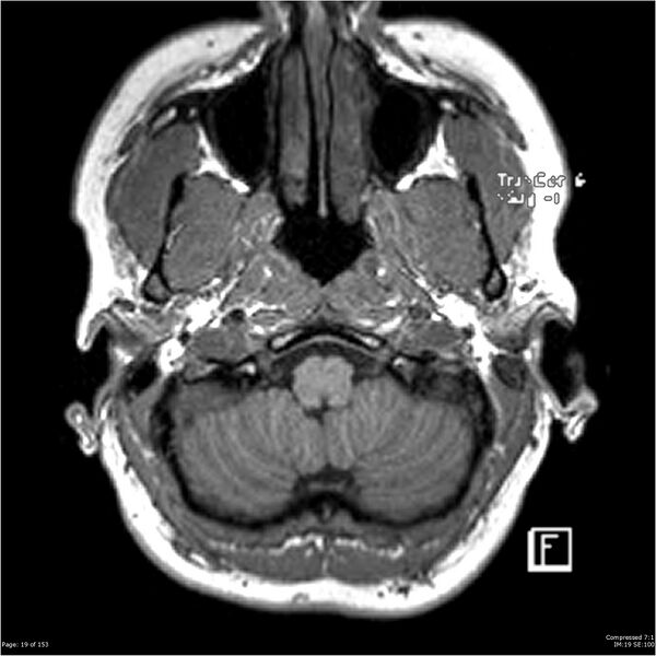 File:Cavernous malformation (cavernous angioma or cavernoma) (Radiopaedia 36675-38237 Axial T1 8).jpg