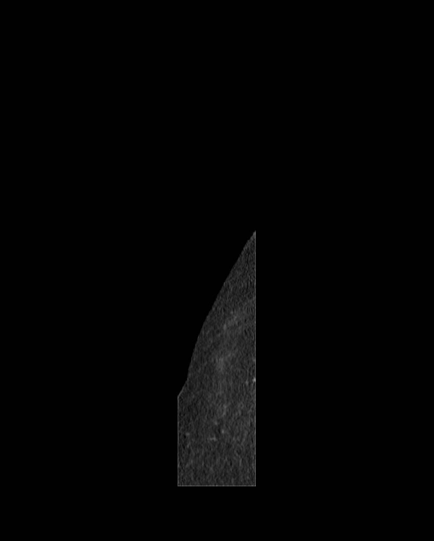 Cecal volvulus (Radiopaedia 54998-61310 C 1).jpg