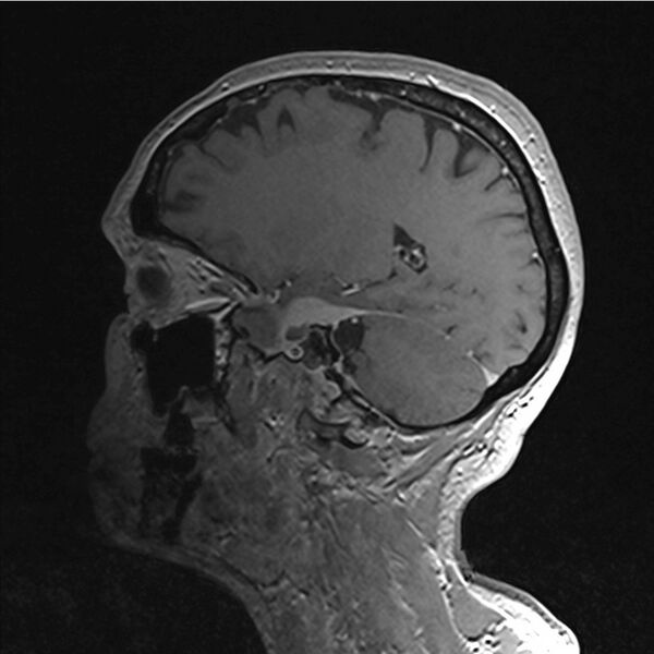 File:Central base of skull meningioma (Radiopaedia 53531-59549 Sagittal T1 C+ 48).jpg