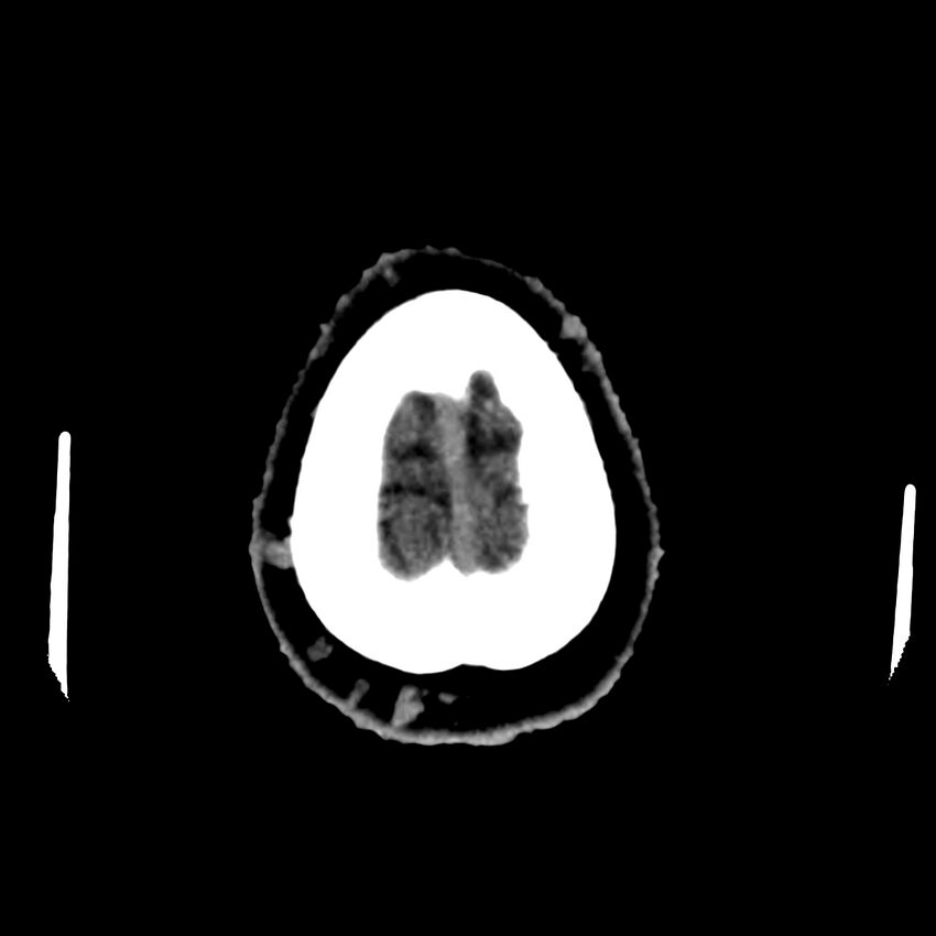 Central nervous system Langerhans cell histiocytosis (Radiopaedia 65728-74878 Axial non-contrast 49).jpg