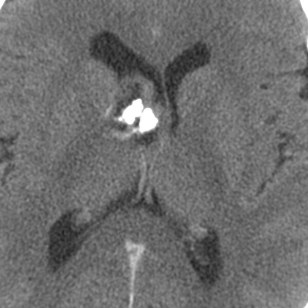 File:Central neurocytoma (Radiopaedia 68725-78432 C 18).jpg