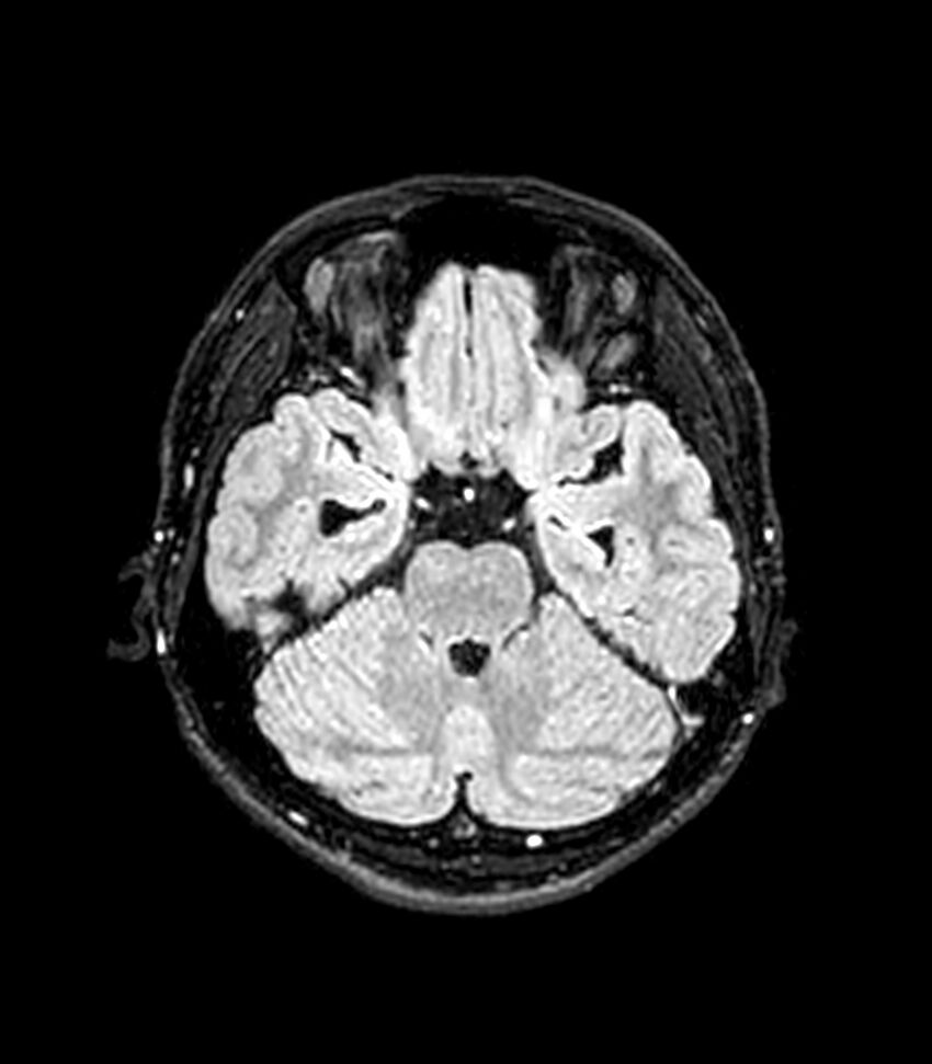 Central neurocytoma (Radiopaedia 79320-92380 Axial FLAIR 209).jpg