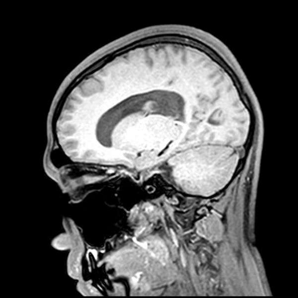 File:Central neurocytoma (Radiopaedia 79320-92380 Sagittal T1 101).jpg