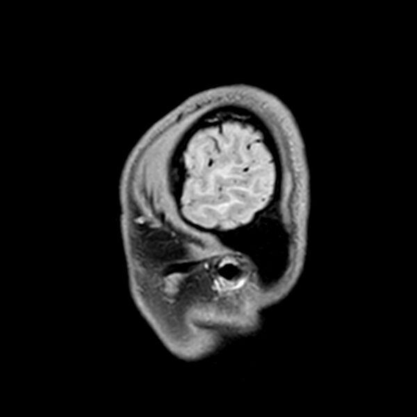 File:Central neurocytoma (Radiopaedia 79320-92380 Sagittal T1 239).jpg