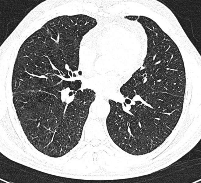 File:Centrilobular pulmonary emphysema (Radiopaedia 26808-26971 Axial lung window 23).jpg