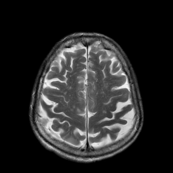 File:Cerebellar ataxia with neuropathy and vestibular areflexia syndrome (CANVAS) (Radiopaedia 74283-85159 Axial T2 17).jpg