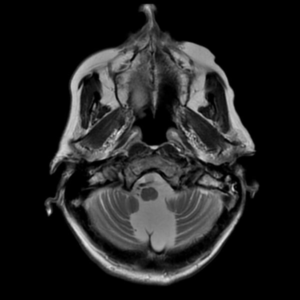 File:Cerebellar ataxia with neuropathy and vestibular areflexia syndrome (CANVAS) (Radiopaedia 74283-85159 Axial T2 4).jpg
