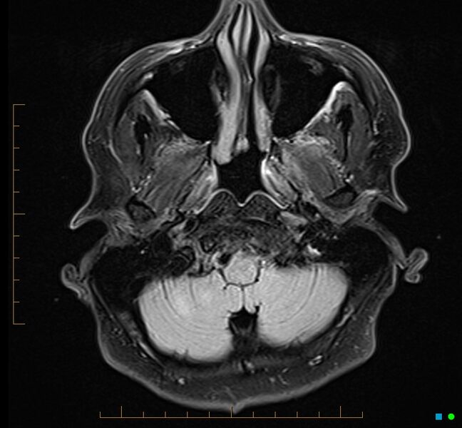 File:Cerebellar gangliocytoma (Radiopaedia 65377-74422 Axial FLAIR 4).jpg