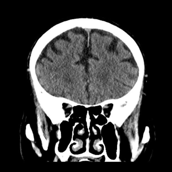 File:Cerebellar hemorrhage (Radiopaedia 27193-27359 Coronal non-contrast 18).jpg