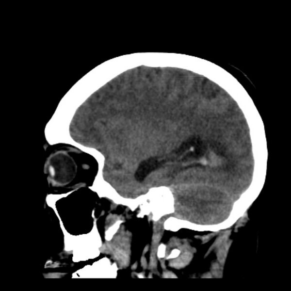 File:Cerebellar hemorrhage causing obstructive hydrocephalus (Radiopaedia 33989-35207 B 34).jpg