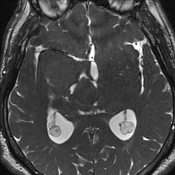File:Cerebellopontine angle meningioma (Radiopaedia 24459-24764 I 50).jpg