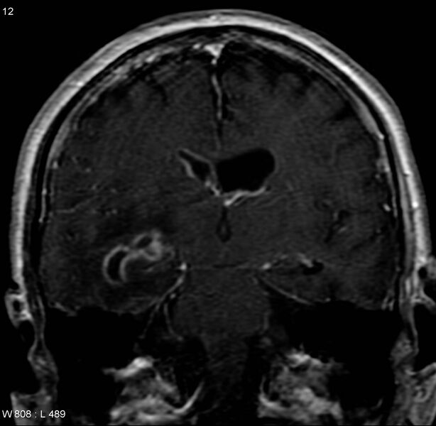 File:Cerebral abscess and ventriculitis (Radiopaedia 5024-6885 Coronal T1 C+ 4).jpg