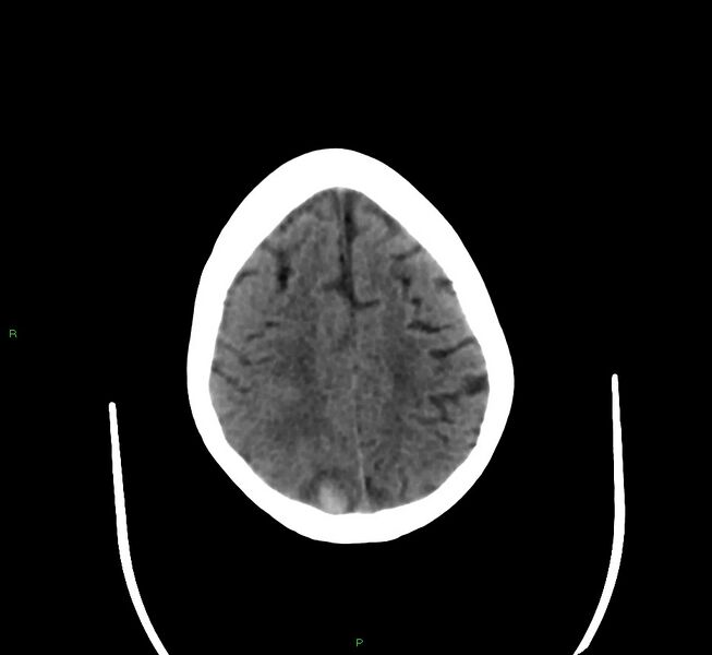 File:Cerebral amyloid angiopathy-associated lobar intracerebral hemorrhage (Radiopaedia 58377-65514 Axial non-contrast 13).jpg