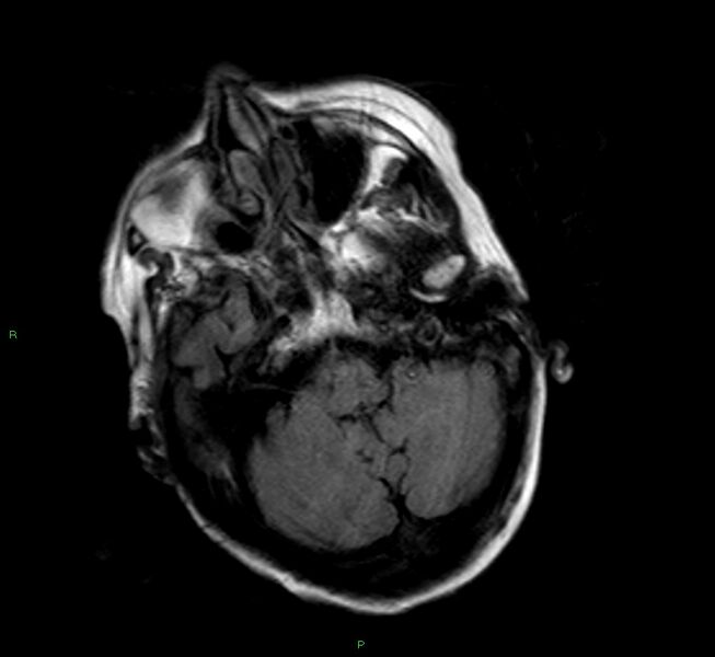File:Cerebral amyloid angiopathy-associated lobar intracerebral hemorrhage (Radiopaedia 58377-65515 Axial FLAIR 21).jpg