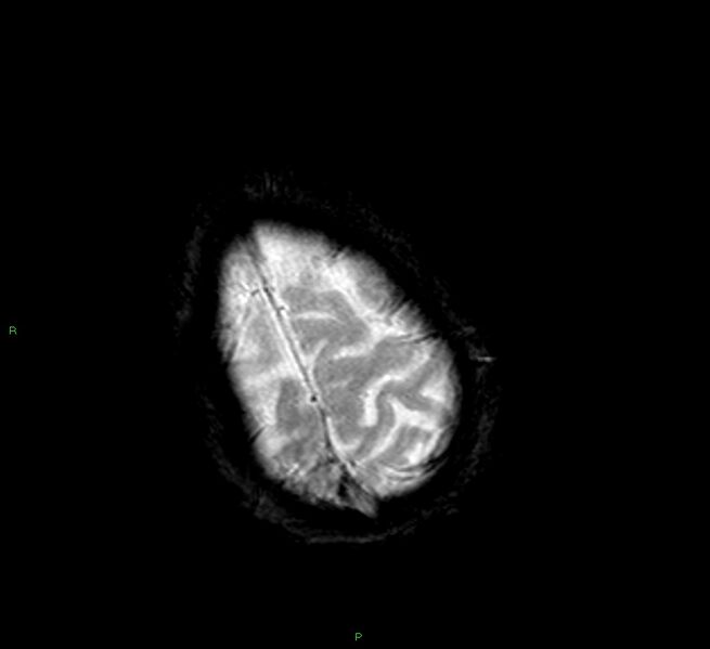 File:Cerebral amyloid angiopathy-associated lobar intracerebral hemorrhage (Radiopaedia 58377-65515 Axial Gradient Echo 5).jpg