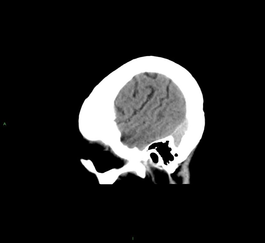 Cerebral amyloid angiopathy-associated lobar intracerebral hemorrhage (Radiopaedia 58378-65516 C 44).jpg