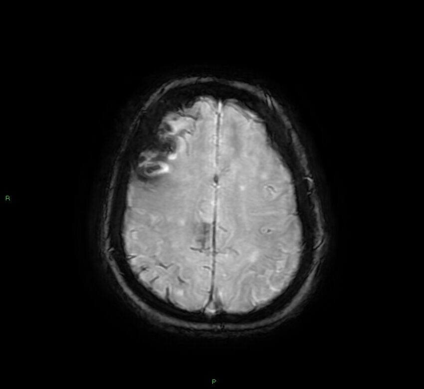 Cerebral amyloid angiopathy-associated lobar intracerebral hemorrhage (Radiopaedia 58378-65517 Axial SWI 57).jpg