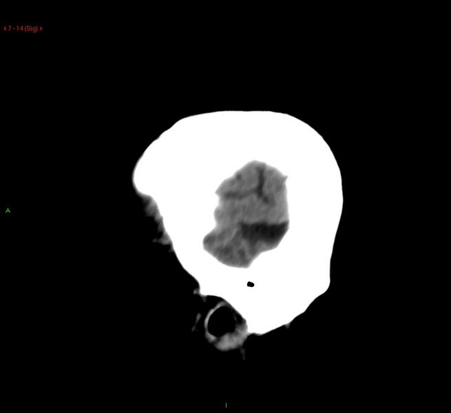 File:Cerebral amyloid angiopathy-associated lobar intracerebral hemorrhage (Radiopaedia 58378-65518 C 14).jpg