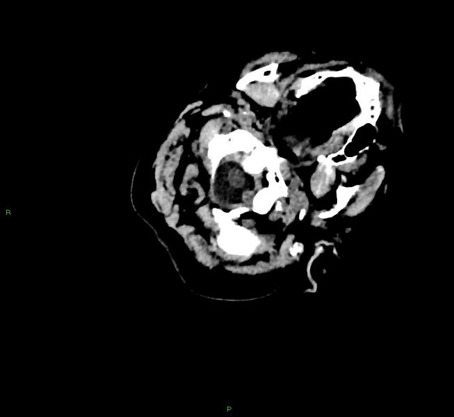 File:Cerebral amyloid angiopathy-associated lobar intracerebral hemorrhage (Radiopaedia 58757-65979 Axial non-contrast 8).jpg