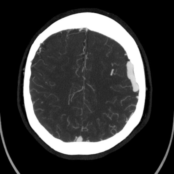 File:Cerebral arteriovenous malformation (Radiopaedia 43729-47189 B 36).jpg