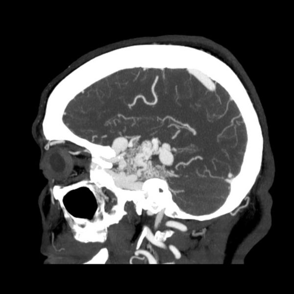 File:Cerebral arteriovenous malformation (Radiopaedia 43729-47189 D 36).jpg
