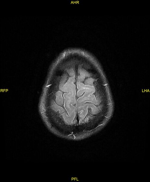 File:Cerebral autosomal dominant arteriopathy with subcortical infarcts and leukoencephalopathy (CADASIL) (Radiopaedia 86108-102054 Axial FLAIR 27).jpg