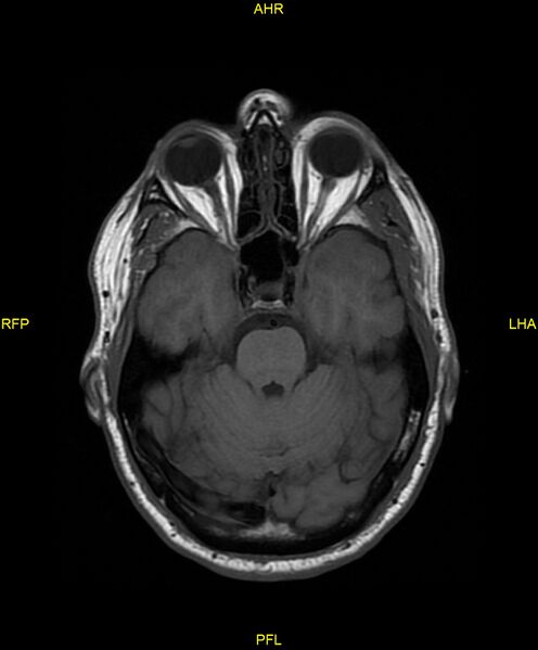 File:Cerebral autosomal dominant arteriopathy with subcortical infarcts and leukoencephalopathy (CADASIL) (Radiopaedia 86108-102054 Axial T1 10).jpg