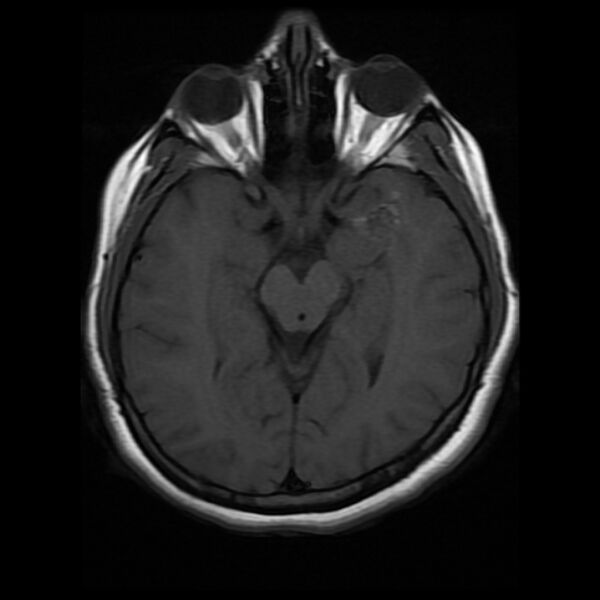File:Cerebral cavernous malformation (Radiopaedia 44301-47942 Axial T1 9).jpg