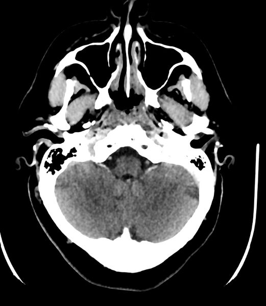 File:Cerebral dural venous sinus thrombosis (Radiopaedia 86514-102575 Axial non-contrast 9).jpg