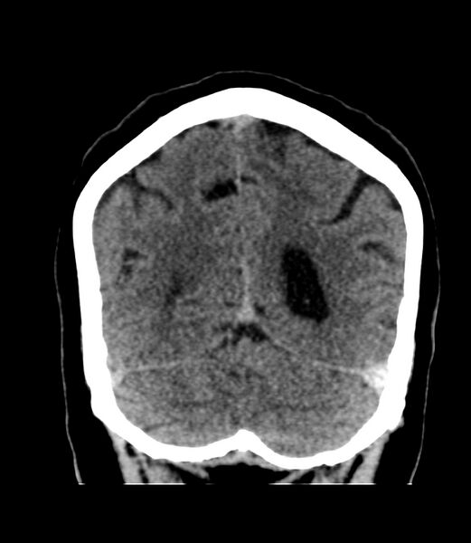 File:Cerebral dural venous sinus thrombosis (Radiopaedia 86514-102575 Coronal non-contrast 40).jpg