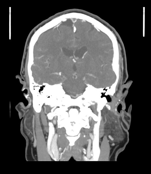 File:Cerebral dural venous sinus thrombosis (Radiopaedia 86514-102576 B 37).jpg