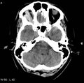 Cerebral hemorrhagic contusion with subdural and subarachnoid hemorrhage (Radiopaedia 10680-11146 Axial non-contrast 5).jpg