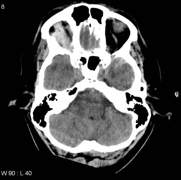 File:Cerebral hemorrhagic contusion with subdural and subarachnoid hemorrhage (Radiopaedia 10680-11146 Axial non-contrast 5).jpg