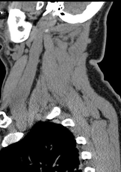 File:Cerebral hemorrhagic contusions and cervical spine fractures (Radiopaedia 32865-33841 G 89).jpg