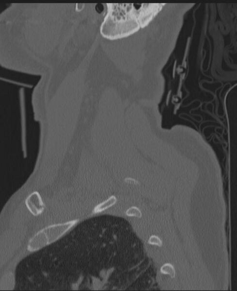 File:Cerebral hemorrhagic contusions and cervical spine fractures (Radiopaedia 32865-33841 Sagittal bone window 12).jpg