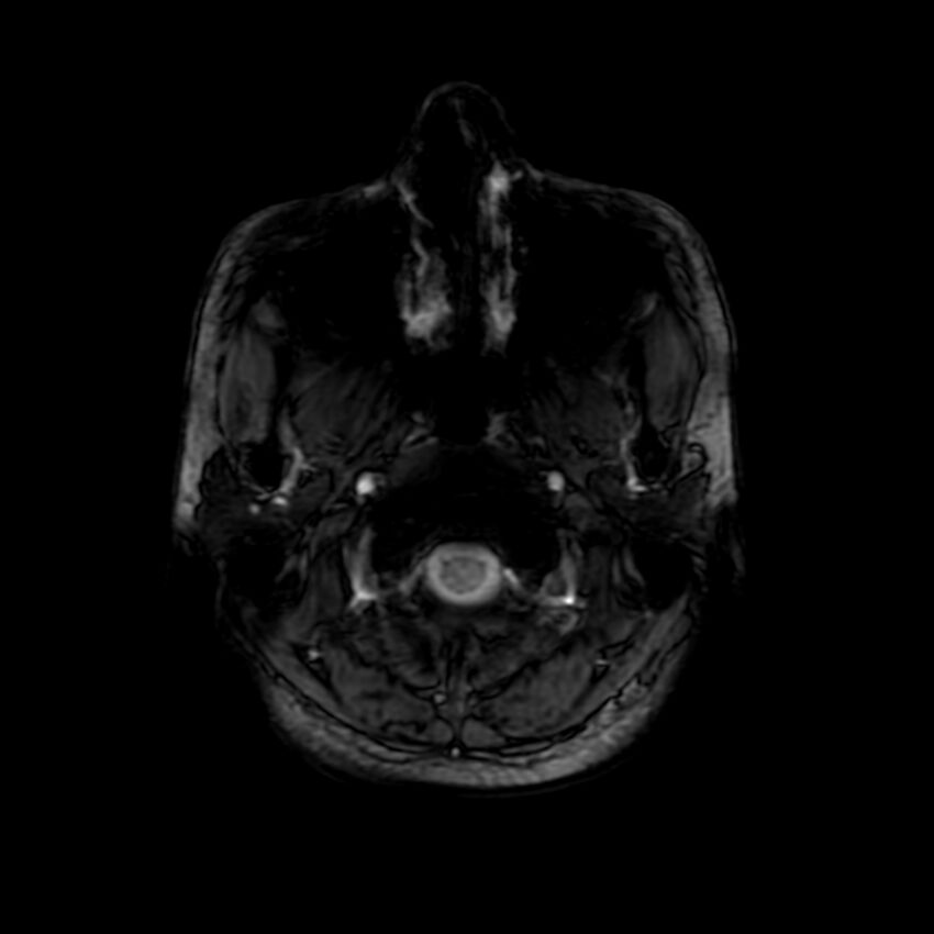 Cerebral paragonimiasis (Radiopaedia 73473-84238 Axial SWI 3).jpg