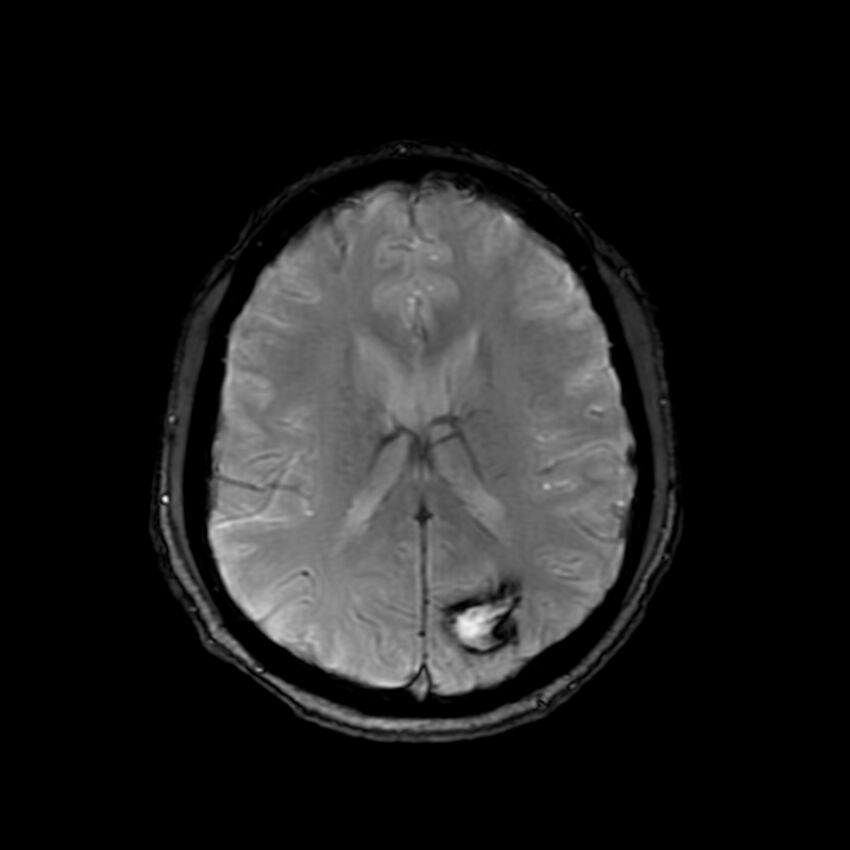 Cerebral paragonimiasis (Radiopaedia 73473-84238 Axial SWI 42).jpg