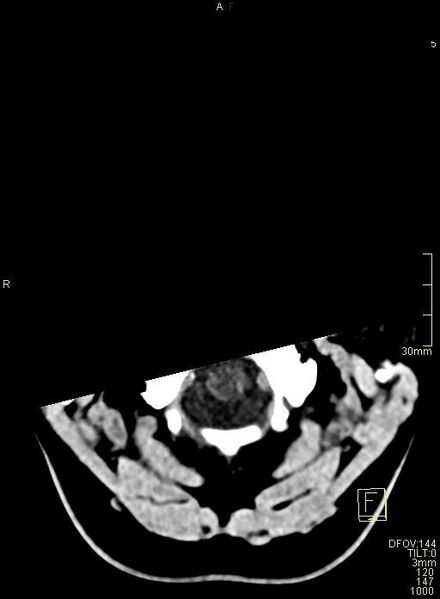 File:Cerebral venous sinus thrombosis (Radiopaedia 91329-108965 Axial non-contrast 3).jpg