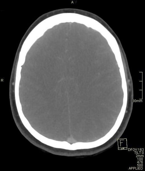 File:Cerebral venous sinus thrombosis (Radiopaedia 91329-108965 Axial venogram 58).jpg