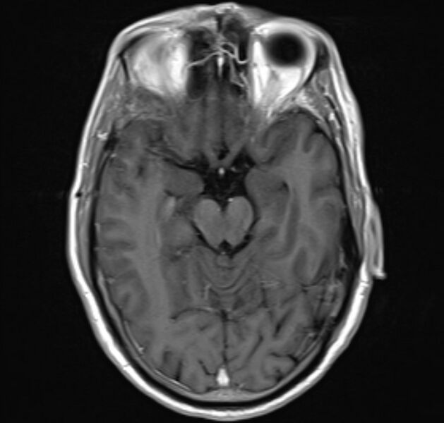 File:Cerebral venous thrombosis (Radiopaedia 71207-81504 Axial T1 C+ 10).jpg