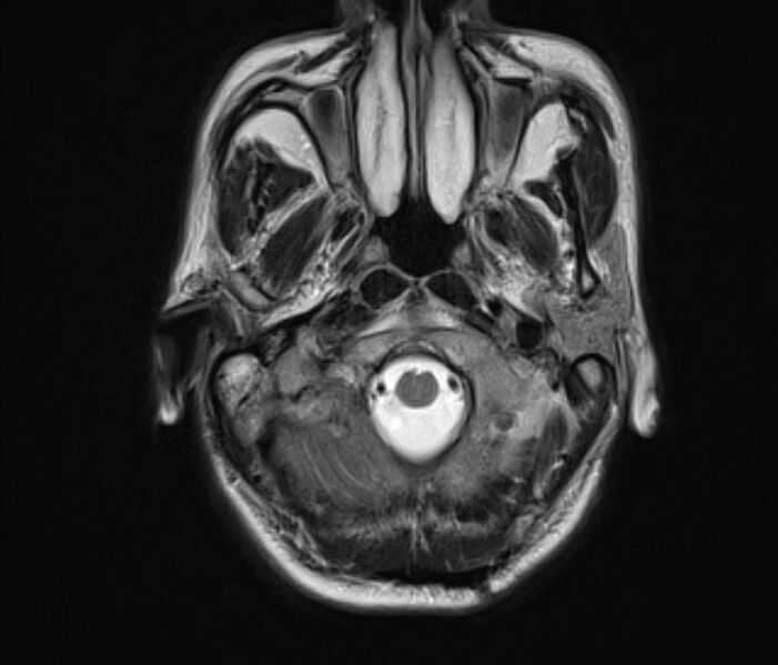 File:Cerebral venous thrombosis (Radiopaedia 71207-81504 Axial T2 4).jpg