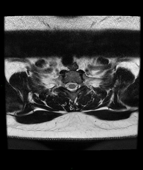 File:Cervical disc prolapse (Radiopaedia 80258-93598 Axial T2 84).jpg