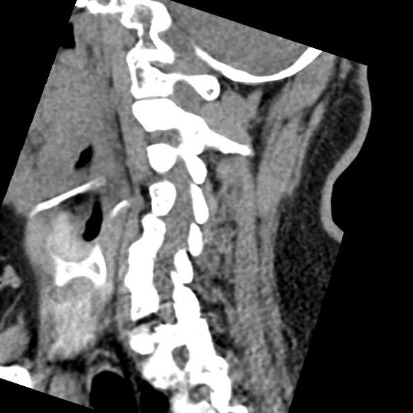File:Cervical spinal neurofibroma in a patient with NF1 (Radiopaedia 58344-65464 C 34).jpg