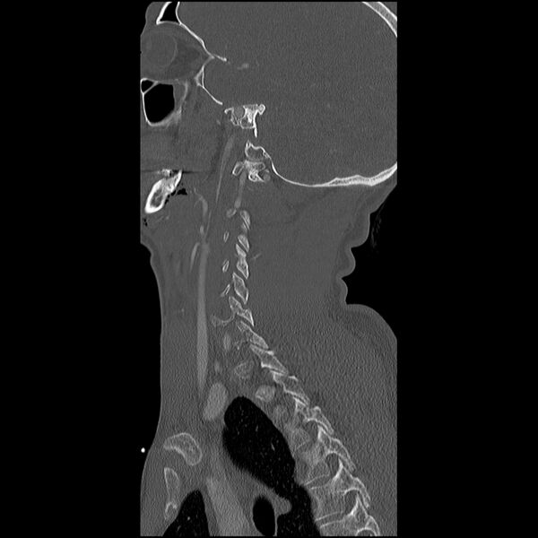 File:Cervical spine fractures with vertebral artery dissection (Radiopaedia 32135-33078 Sagittal bone window 8).jpg