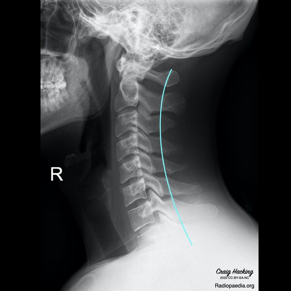 File:Cervical spine lines (Radiopaedia 76069-87571 G 1).jpeg