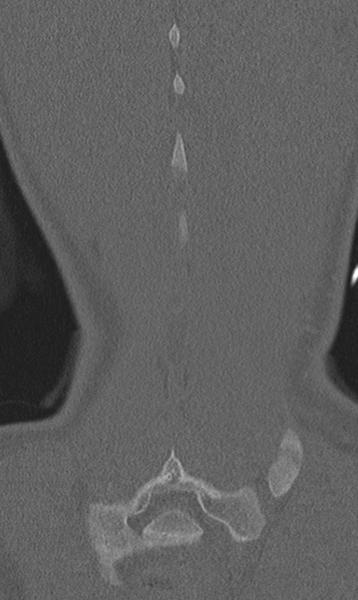File:Chance fracture (Radiopaedia 40360-42912 Coronal bone window 65).png