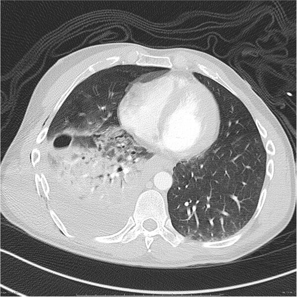 File:Chest and abdomen multi-trauma (Radiopaedia 26294-26425 lung window 71).jpg