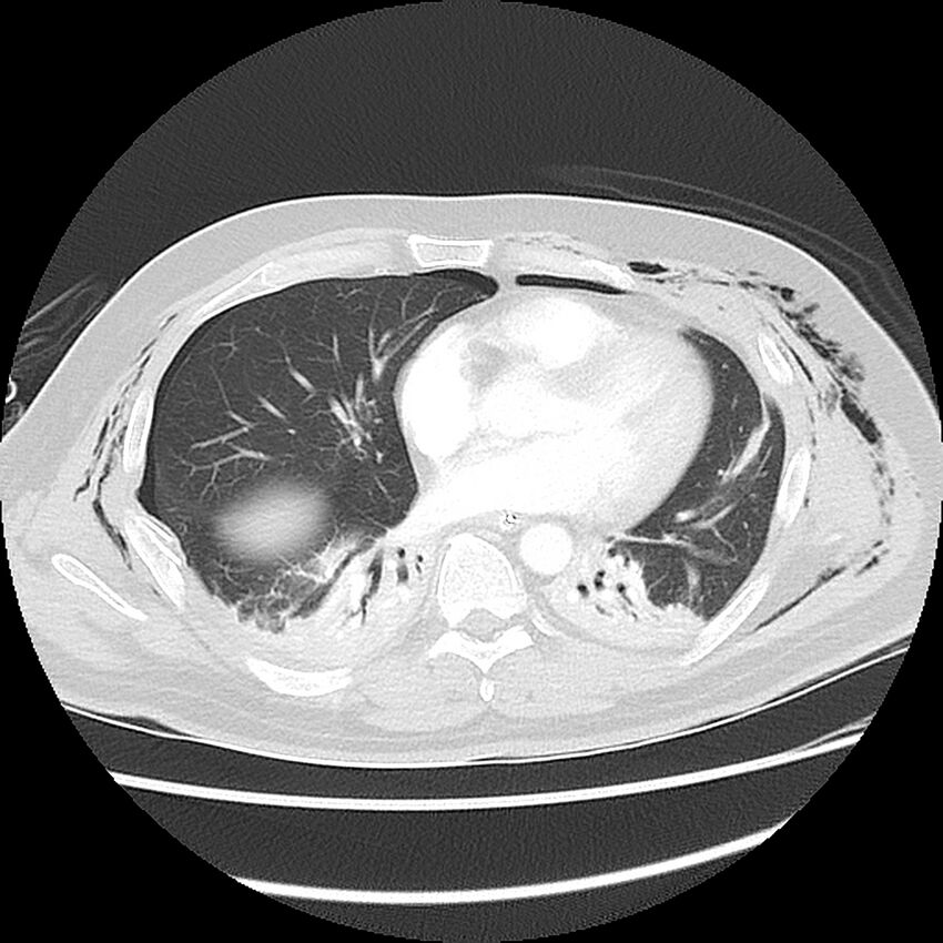 Chest crush injury (Radiopaedia 31620-32513 Axial lung window 35).jpg